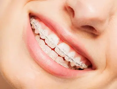 Brackets estéticos en Arahal, Sevilla