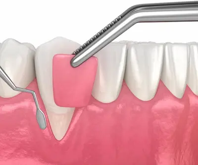 Injertos periodontales en Arahal, Sevilla