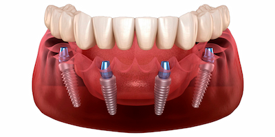 Protesis sobre implantes en Arahal, Sevilla